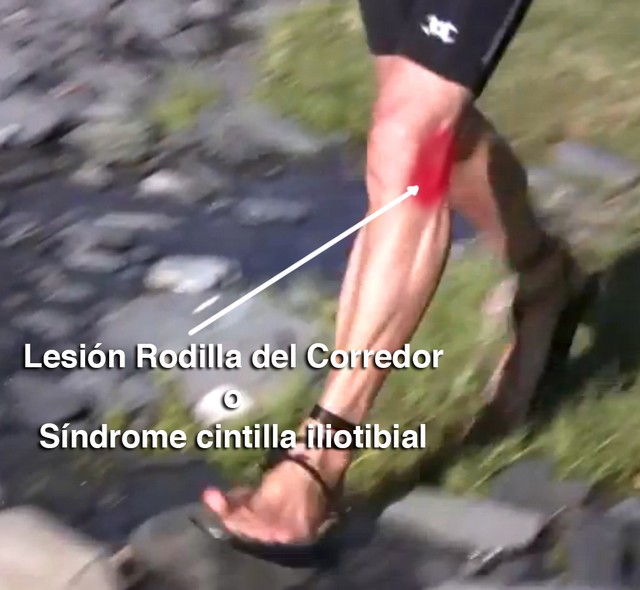 Lesión Rodilla del Corredor o Síndrome cintilla iliotibial